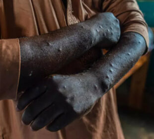 Pacijent inficiran mpox-om u Kamitugi istočni Kongo 2024