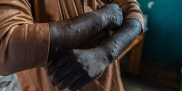 Pacijent inficiran mpox-om u Kamitugi istočni Kongo 2024