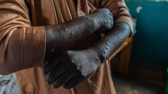 Pacijent inficiran mpox-om u Kamitugi istočni Kongo 2024